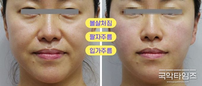 자가 진피재생술